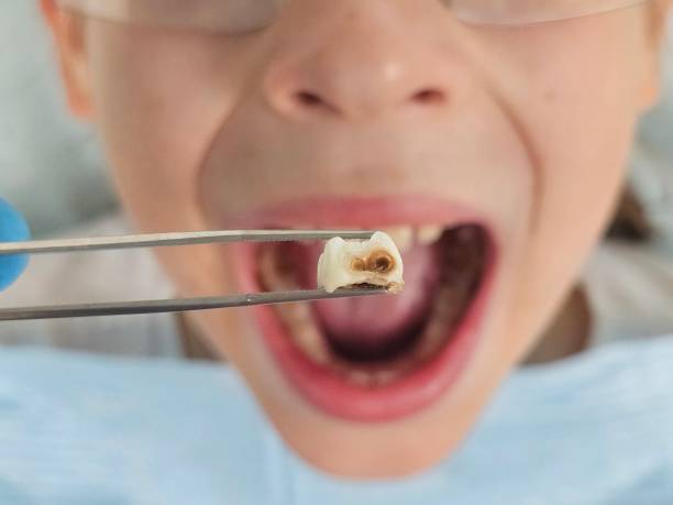 Best Emergency Dental Extractions in Mount Airy, GA